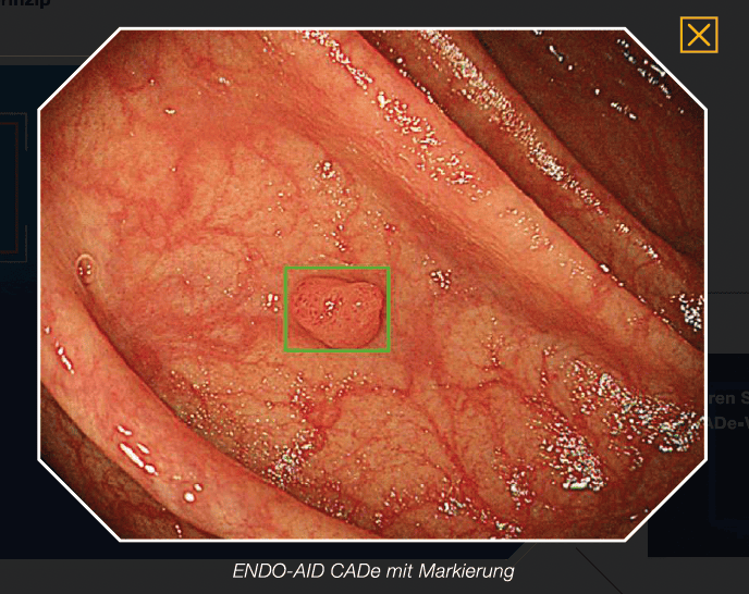 Künstliche Intelligenz in der Endoskopie im Endoskopiezentrum Stockerau mit Olympus